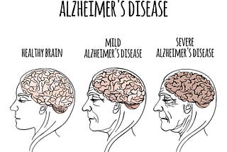 Alzheimer’s Disease: The Stages of the Disease