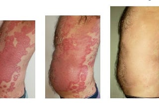 How to reverse Autoimmune & Chronic Conditions FAST: Obesity, Psoriasis, Lupus, Crohns, IBS…