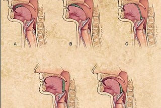 Figure showing 5 different mechanical steps of swallowing.