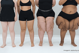 Cirurgia de Lipedema: o que é, quem pode fazer