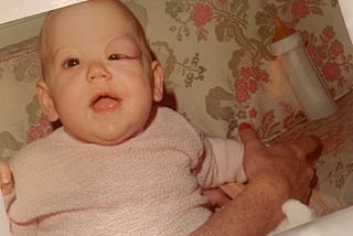 An infant with a swollen and bulging left eye, with 1970’s wallpaper and a bottle in the background. The infant is smiling at her mother, whose hand is visible holding her.