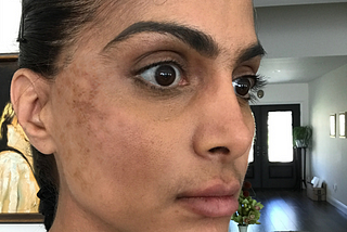 How to remove Dark Spots on Face overnight?