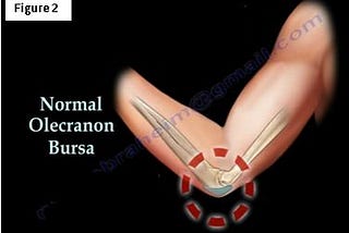 Bursitis of the Elbow