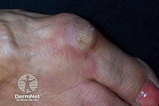 5 Surprising Facts About Callus You Didn’t Know