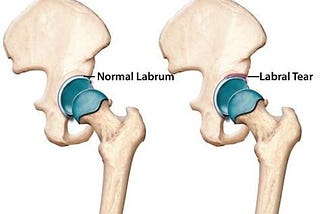 Why I decided to have surgery during a pandemic: Hip osteoplasty and labral repair