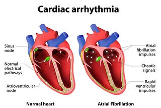 Arrhythmia — Know It All!