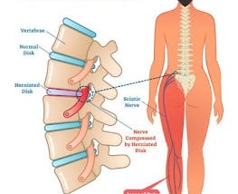 Understanding Sciatica: Causes, Symptoms, and Effective Treatments