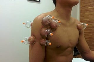 Cupping Therapy In Delhi, Procedure, Pros, and Cons