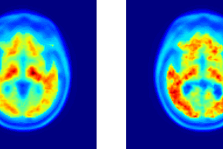 Breakthrough: Brain-Amyloid Imaging via EEG