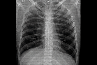 Medical X-ray ⚕️ Image Classification using Convolutional Neural Network