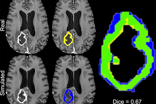 Image Segmentation — Multimodal Brain Tumor Semantic Segmentation Using 3D U-Net Architecture