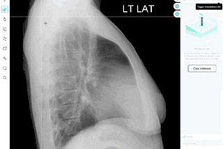 The automated segmentation of a lung in a lateral thoracic x-ray