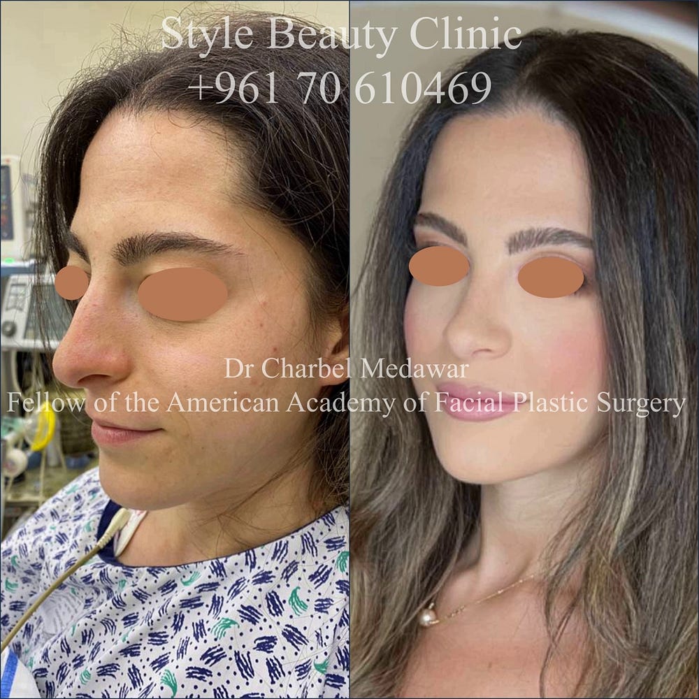 Nose Plastic Surgery Lebanon Dr Charbel Medawar Style Beauty Clinic