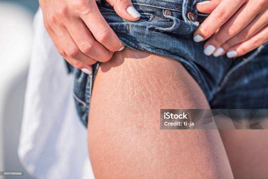 Best Techniques to Coverup Stretch marks by Emaan Sarwar Medium