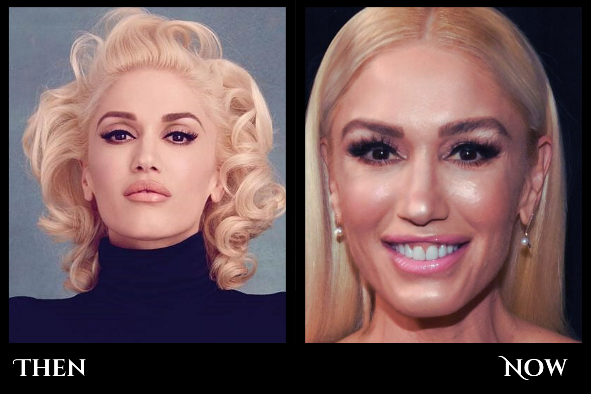Gwen Stefani Plastic Surgery — The Truth Revealed by ASHISH KUMAR(00)