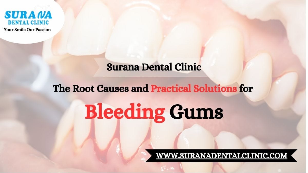 The Root Causes and Practical Solutions for Bleeding Gums | by Surana ...