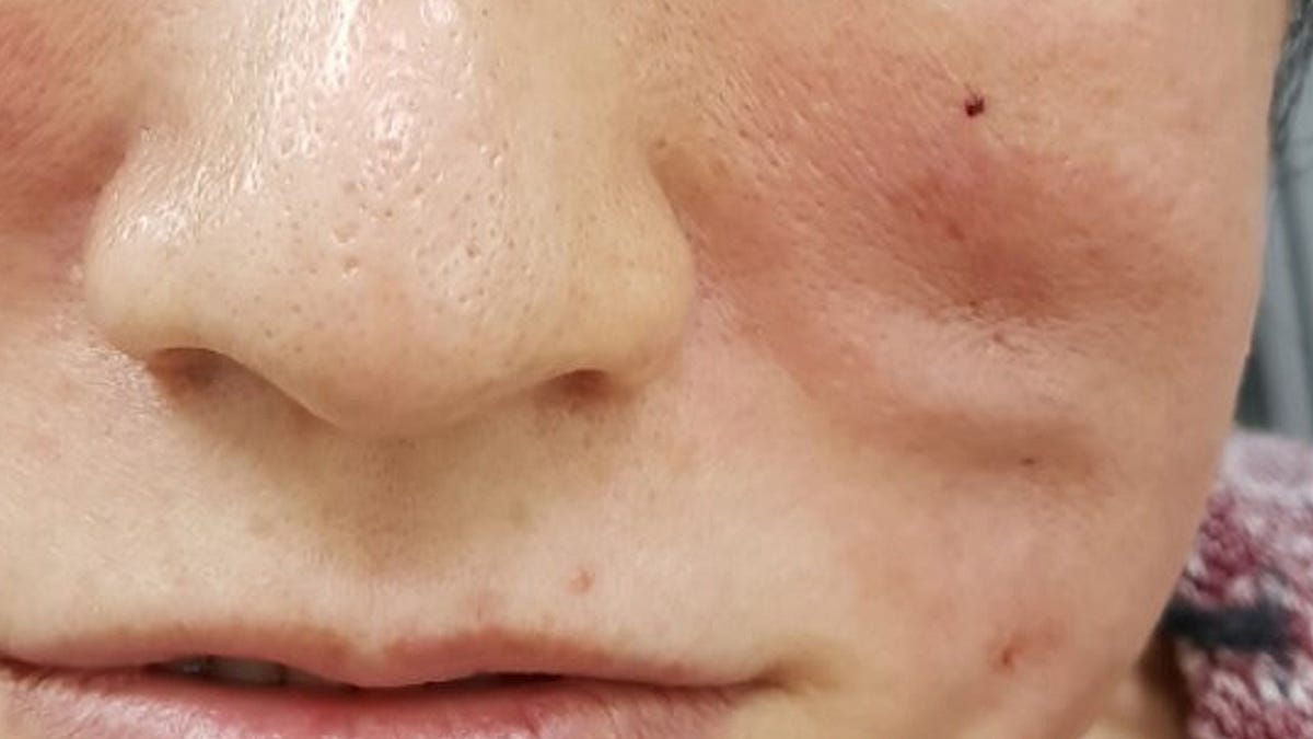 Thread Lift Puckering What You Need to Know by drahmadclinic Jun