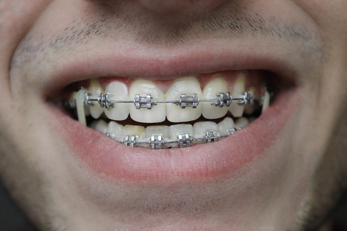 The Average Cost of Braces vs Invisalign