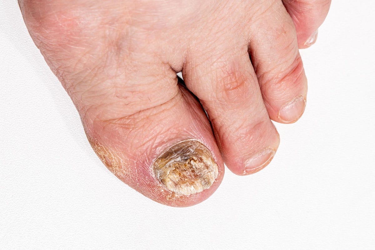 How to Get Rid of Fungal Toenail Infections by Mustafeliveali Medium