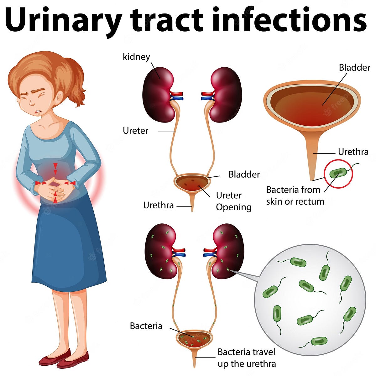 Urinary Tract Infection (UTI) Risk Factors, Causes, Symptoms, and Treatment by M.S. Medium