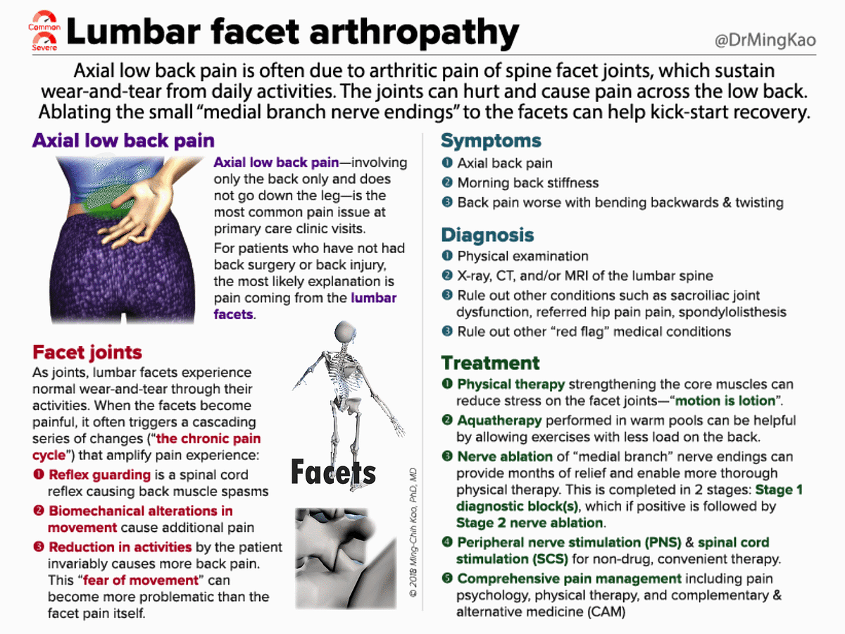 Lumbar facet arthropathy. Axial low back pain is often due to… | by Dr ...