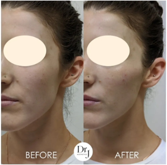 Rejuvenating Your Skin A Comprehensive Guide to anti wrinkle
