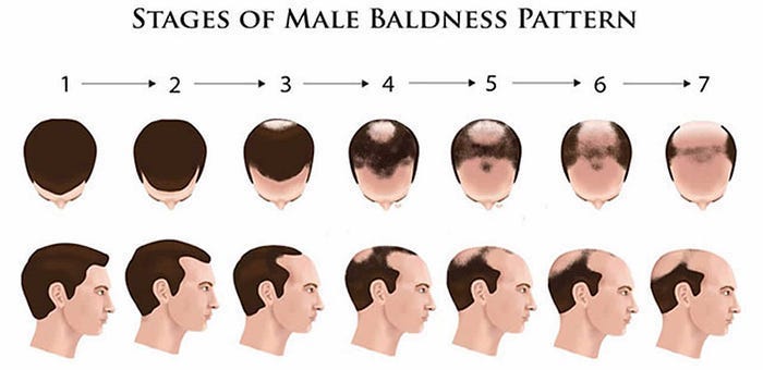 Effective Treatments For Male Pattern Baldness In 2024 By Aysha Khan   0*pWKa60SBZIVzm74L