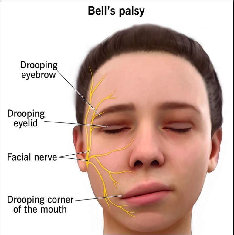 Empowering Recovery: A Deep Dive into Bell’s Palsy Resilience | by HCG ...