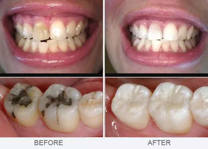 Best Root Canal Treatment Costs in Pune/Near Me Microdent Dentistry