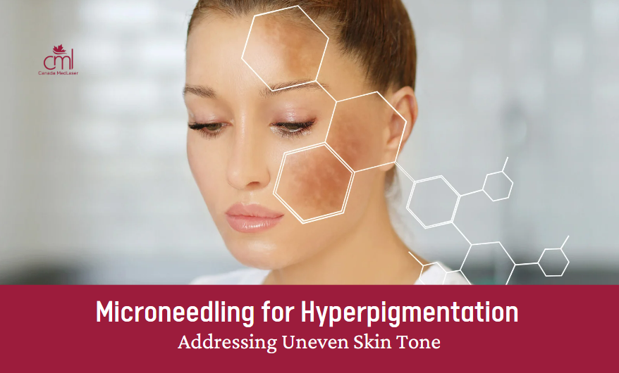 Microneedling for Hyperpigmentation by Alex Jan, 2024