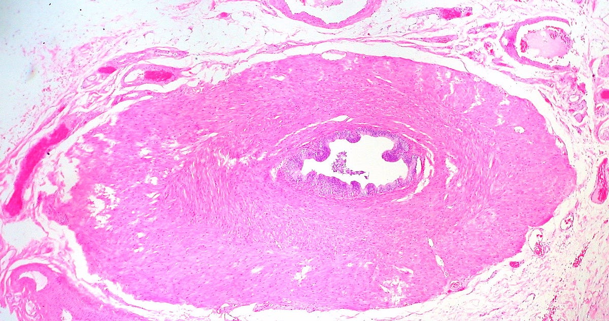 A Failed Vasectomy Changed My Life by Don Johnson Human Parts