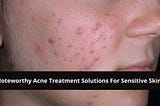 Acne Treatment For sensitive skin — Livekaktus