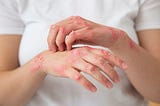 Strategies to Avoid Eczema Relapses