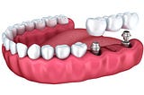 Dental Implant Bridges Save Surrounding Teeth