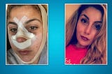 Nose Plastic Surgery and Selfie