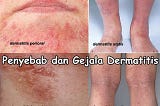 Obat gatal alergi bentol kulit kecil merah