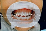 How Teeth Whitening Works