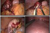 Acute Appendicitis with Pyogenic Liver Abscesses