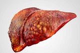How Fructose Causes Non-Alcoholic Fatty Liver Disease