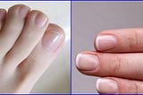 Cómo Curar Los Hongos de las Uñas Rápidamente 100% Natural