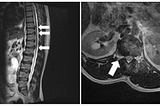A Case of Thoracic Disc Herniation Effectively Treated with Interventional Radiology Computed…
