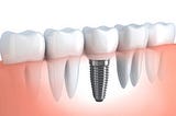 Thời điểm cấy ghép Implant cho người mới nhổ răng