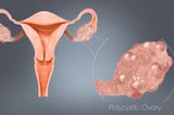 PCOS: A Mysterious Disorder