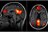 Default Mode Network and Sports