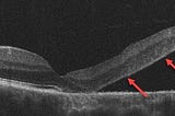 SURGICAL RETINA CENTRE