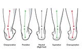 Decoding Overpronation vs Underpronation: Unveiling the 5 Secret to Optimal Foot Health