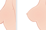 What is Breast Uplift — Mastopexy?