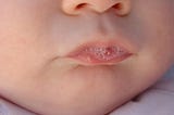 “Morning Saliva for Your Acne Scars!” Eww to Wow Moment!!