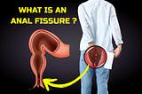 Understanding Anal Fissures: Causes, Symptoms, and Treatment