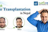 best hair transplant in nepal Healthy Choice Aesthetic Hospital